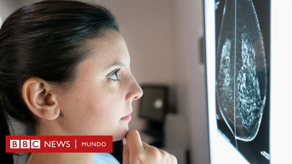 El Modelo Que Permite Predecir Que Riesgo De Recaida Tiene Un Cancer De Mama Bbc News Mundo