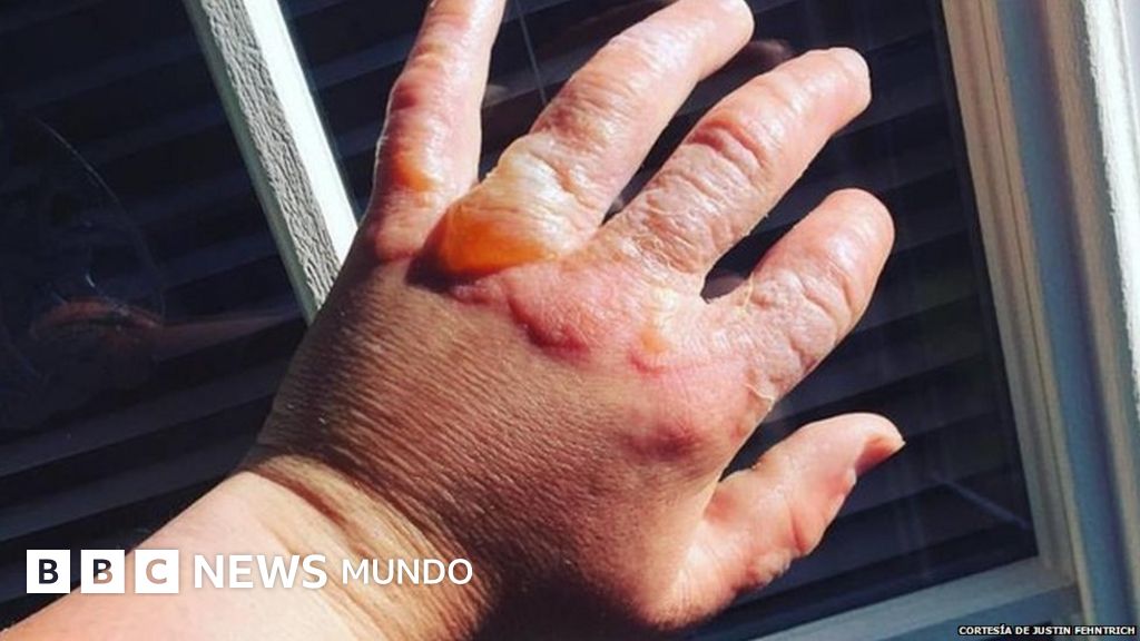 Quemaduras por el limon