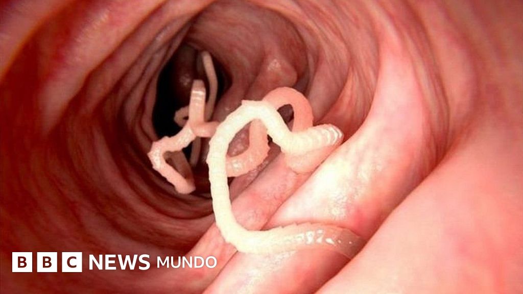 parasitos intestinales de niños parasitos intestinales de niños