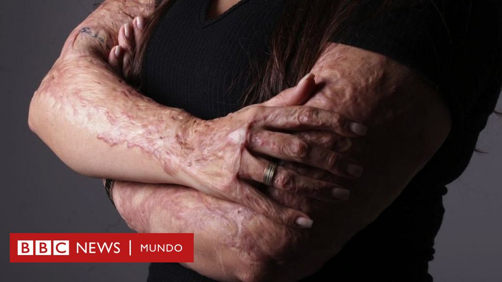 “Acepté las quemaduras, pero no mi pierna amputada”: el testimonio de una sobreviviente del incendio de la discoteca brasileña que dejó 240 muertos hace 10 años