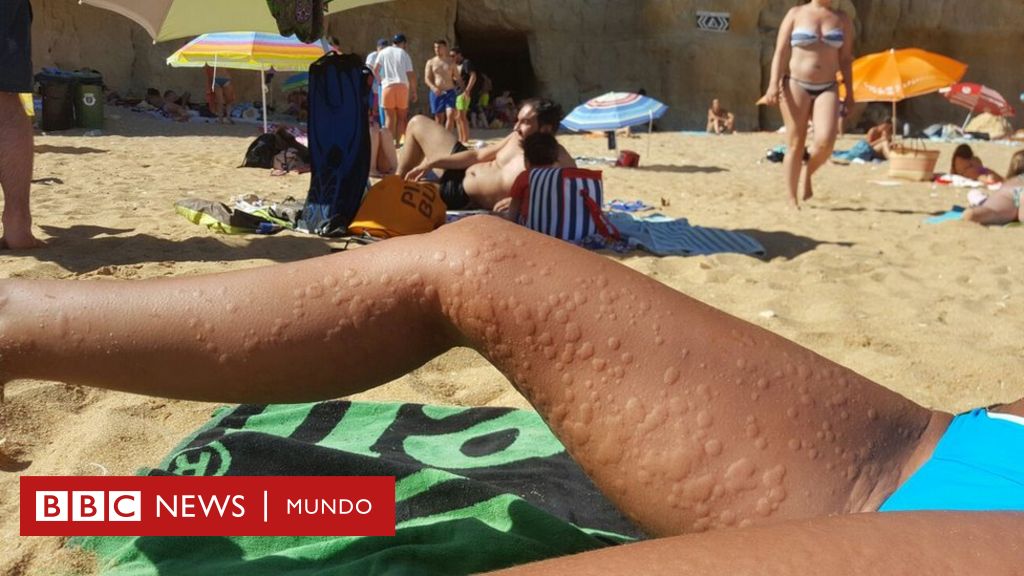 Puede que cuando estas con urticaria comer se