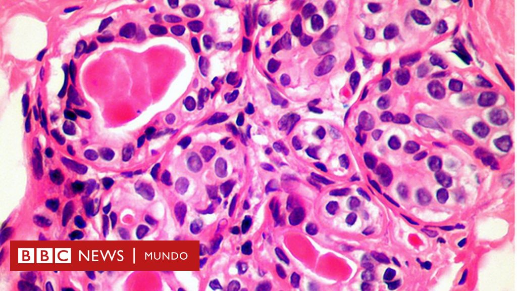como nace el cancer de prostata