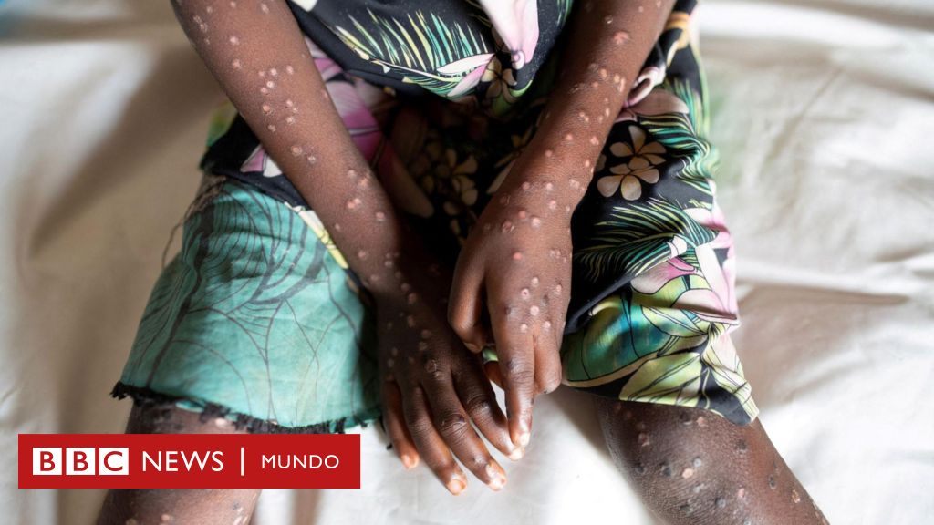 Mpox (formerly monkeypox): WHO declares international health emergency over monkeypox outbreak