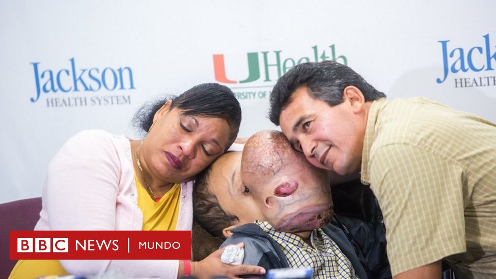 Muere Emanuel, el niño cubano con un gigantesco tumor en la cara que fue  operado en Estados Unidos - BBC News Mundo