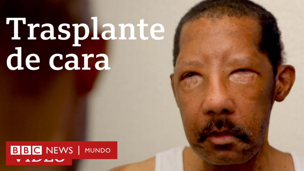 Trasplante De Cara Mi Nueva Vida Con El Rostro De Un Extrano c News Mundo