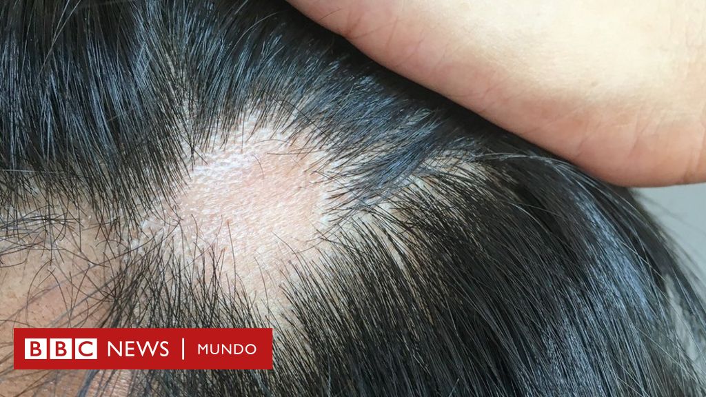 helmintikus terápia alopecia areata