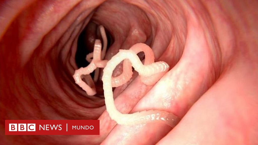 Lombrices oxiuros - Parasitos intestinales oxiuros tratamiento natural