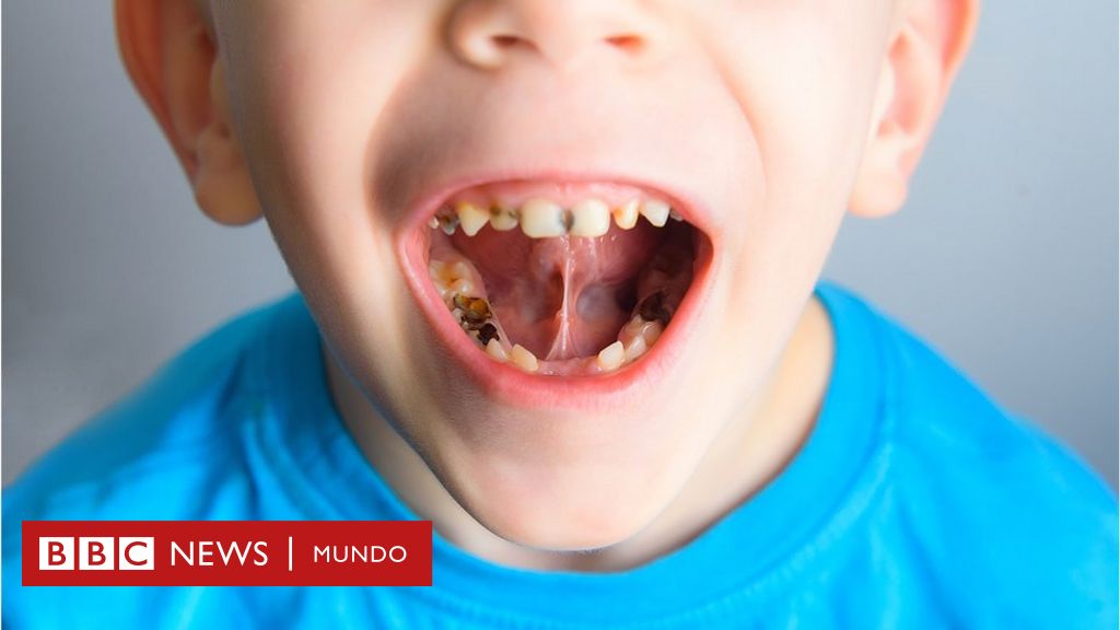 Qué es la caries dental y cómo prevenirla