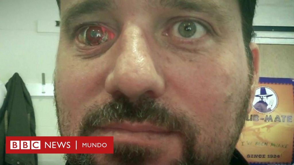 compensar tobillo equilibrio Por qué instalé una cámara dentro de mi ojo: la historia de Rob Spence, el  hombre que creó un "eyeborg" - BBC News Mundo