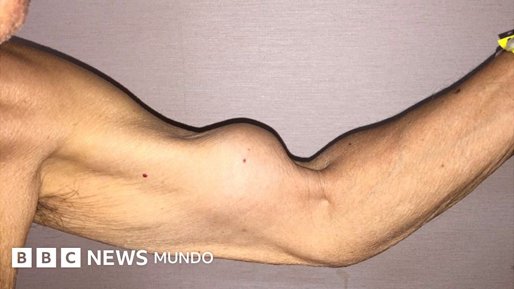 Dolor al levantar el brazo por encima del hombro