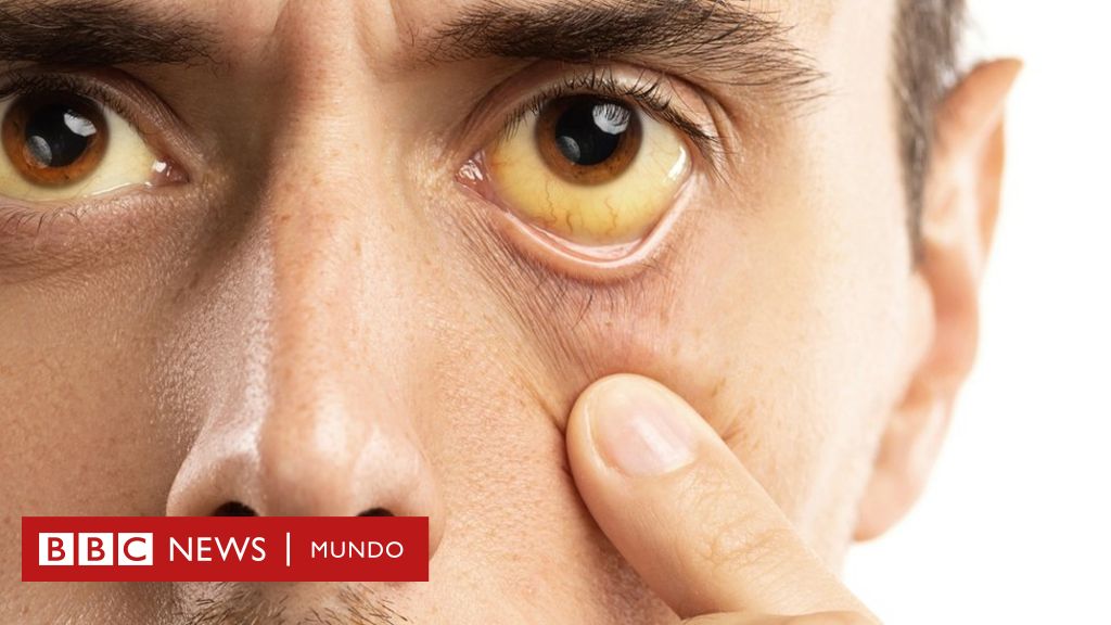 Lo que tus ojos pueden revelar de tu salud - BBC News