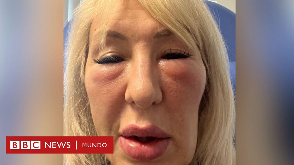 "Pagué millones de dólares por rellenos en la cara a un médico que me engañó y ahora parezco una gárgola"