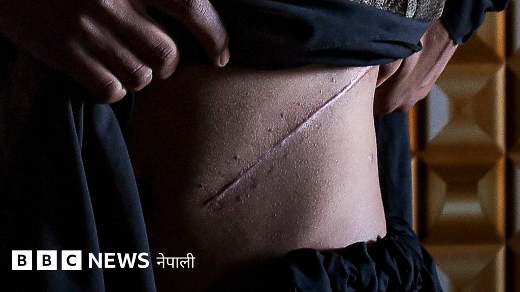 मिर्गौला व्यापार : अङ्गको अवैध बिक्री गर्न भारत पुग्छन् म्यान्मारका गाउँले