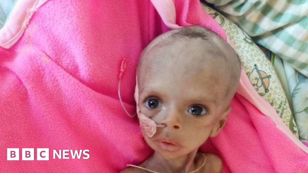 Ethiopia civil war: Tigray hospital running out of food for starving children