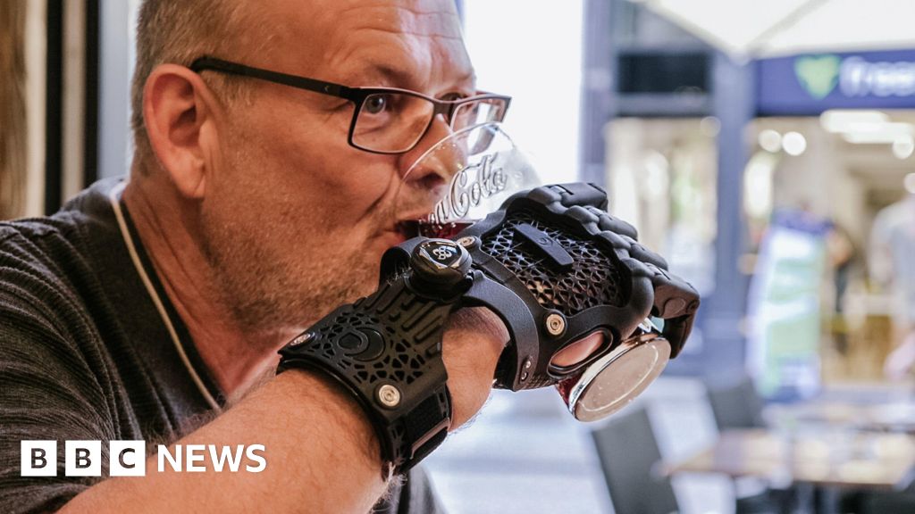 Bristol: First person receives pioneering bionic hand – BBC News