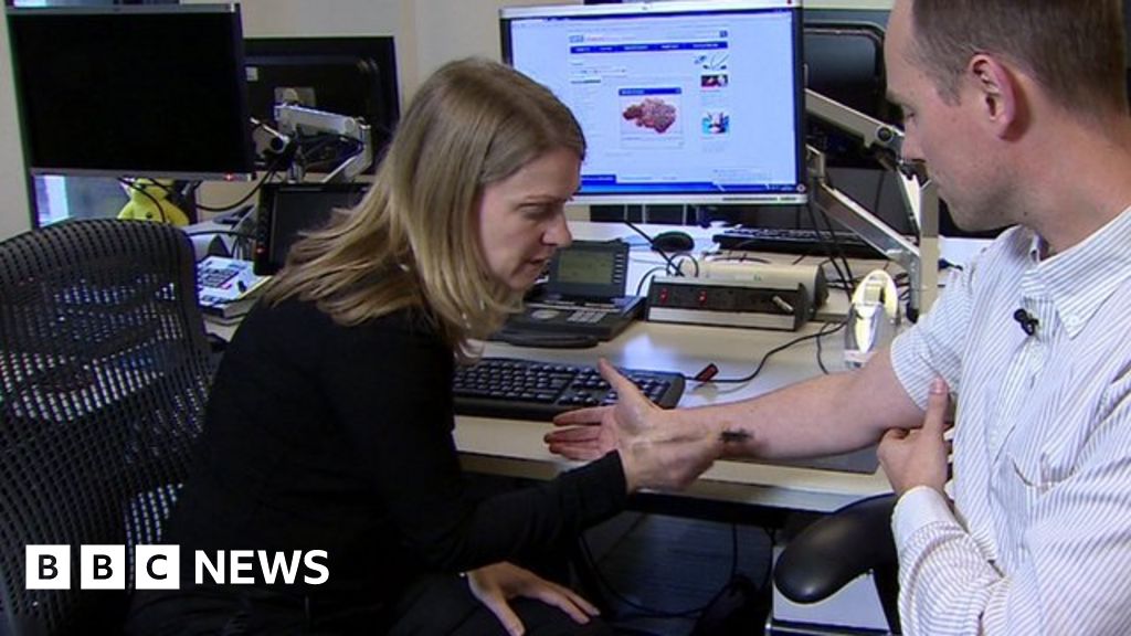 Arm Mole Count Predicts Skin Cancer Risk Bbc News