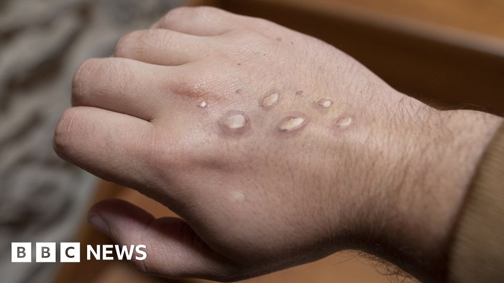 Law makes monkeypox a notifiable disease in England
