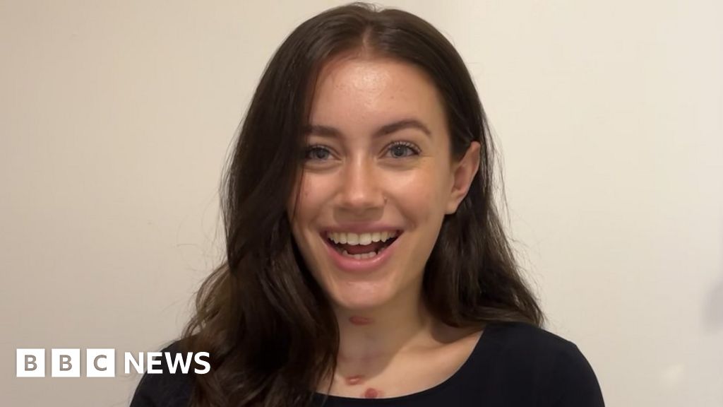 Dating with cancer: ‘It was the first thing people noticed'