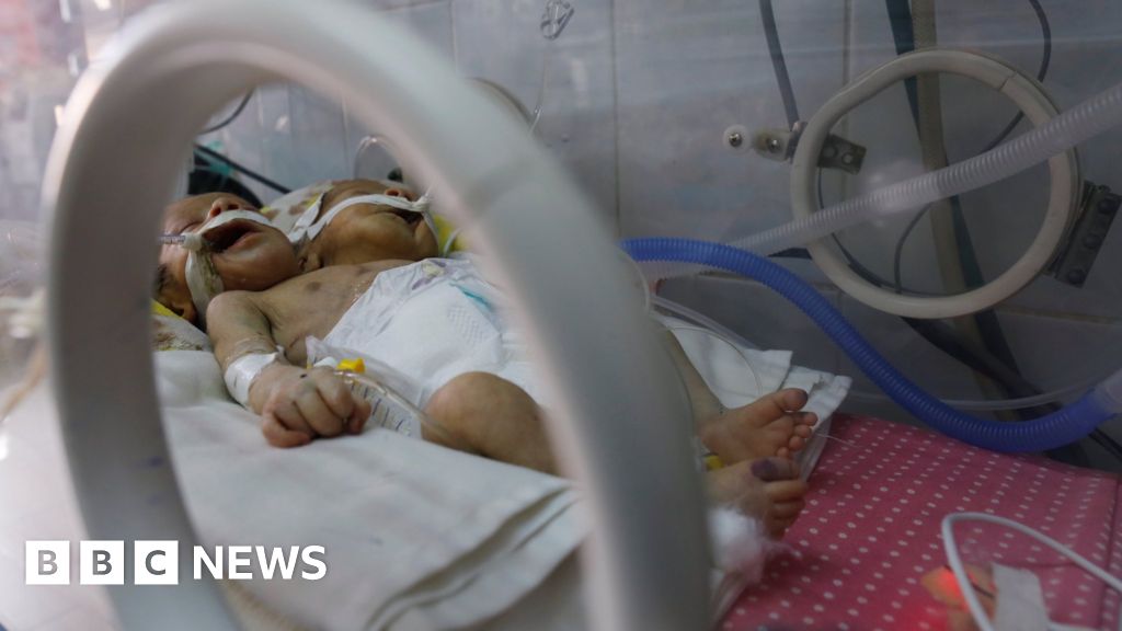 Yemen Conjoined Twins Doctors Appeal For Help Evacuating Boys Bbc News 3517