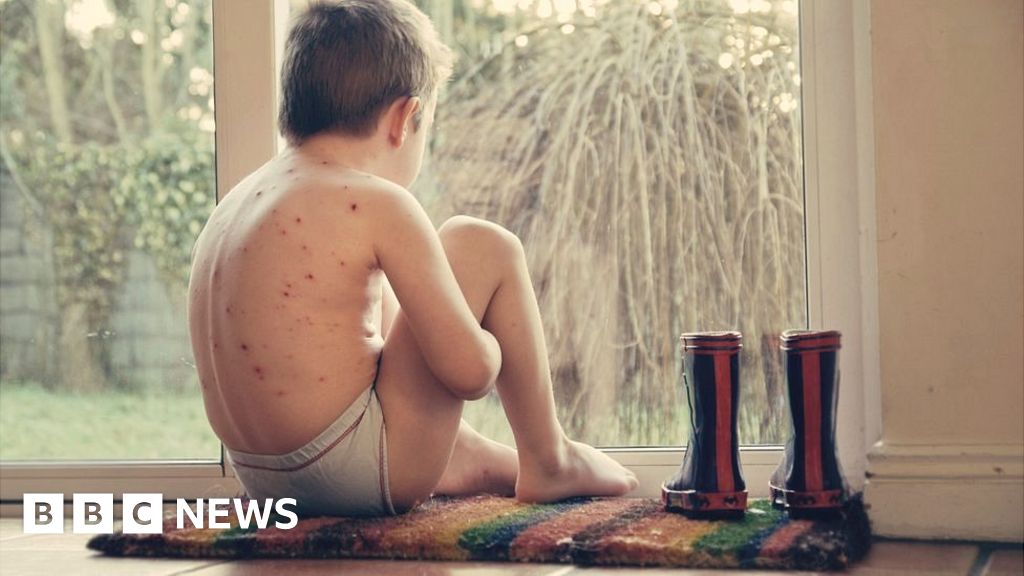 Give toddlers chickenpox jab, advisers tell NHS