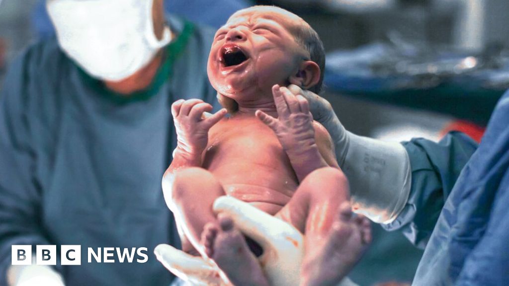 NHS England drops limit on offering Caesarean births