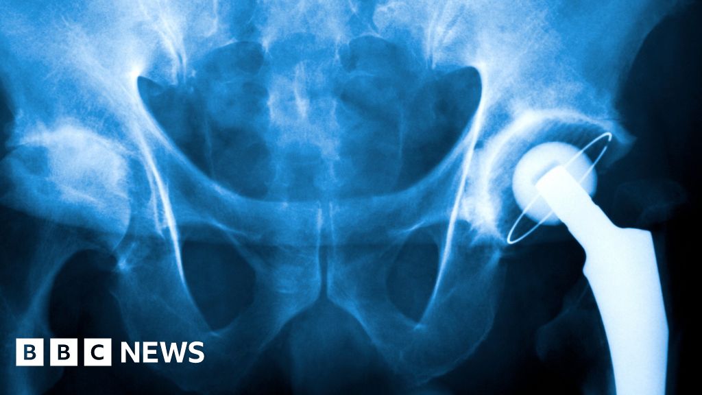 NHS Wales Swansea tops hospital waiting lists for knees, hips