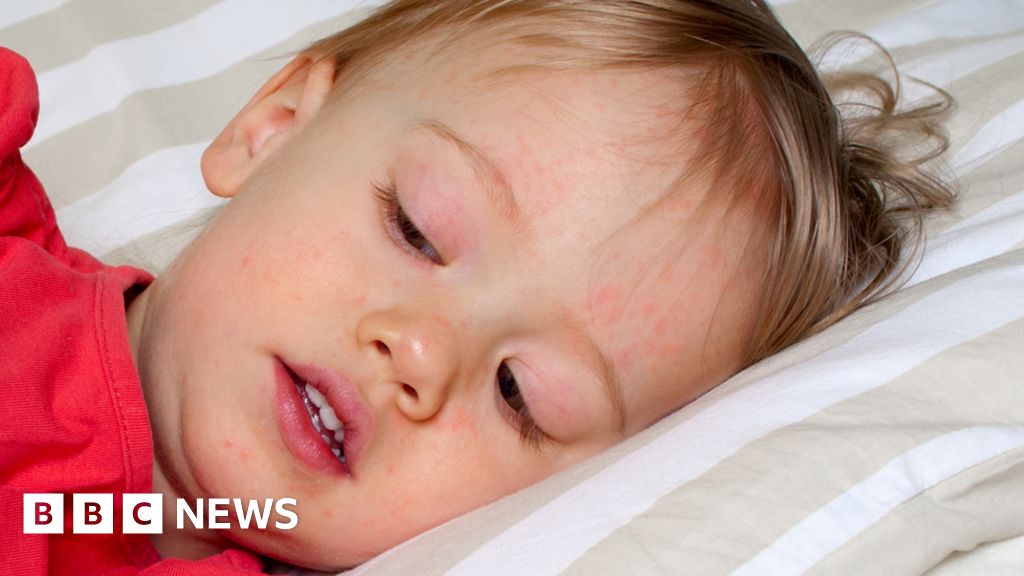 Scarlet Fever Cases Hit 50 Year High In England    98953640 Scarletfevergetty 