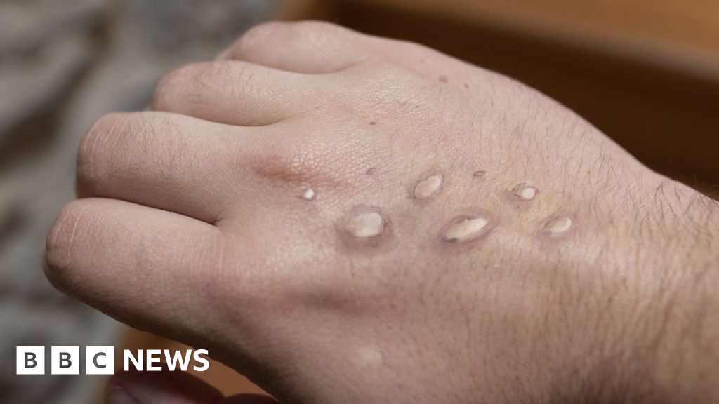 Monkeypox: First Singapore case recorded in British flight attendant