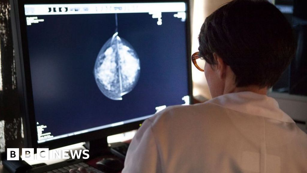 AI offers huge promise on breast cancer screening