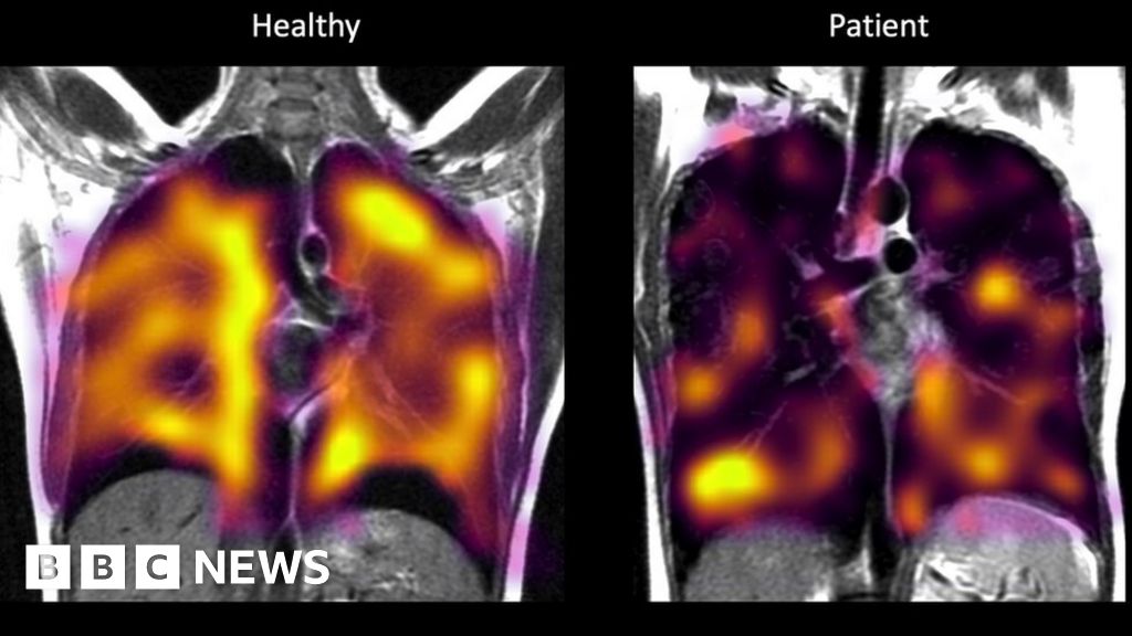 Long Covid: Hidden lung damage spotted on scans – BBC News