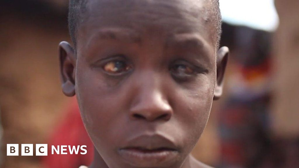 Trachoma: A race to save James's eyesight - BBC News