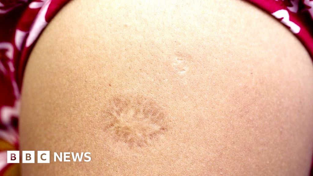 Coronavirus BCG Rumours And Other Stories Fact checked