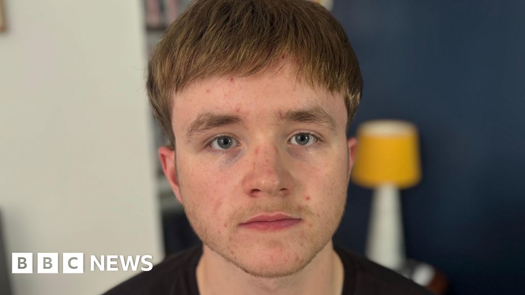 ‘Losing my hair at 16 has controlled me’