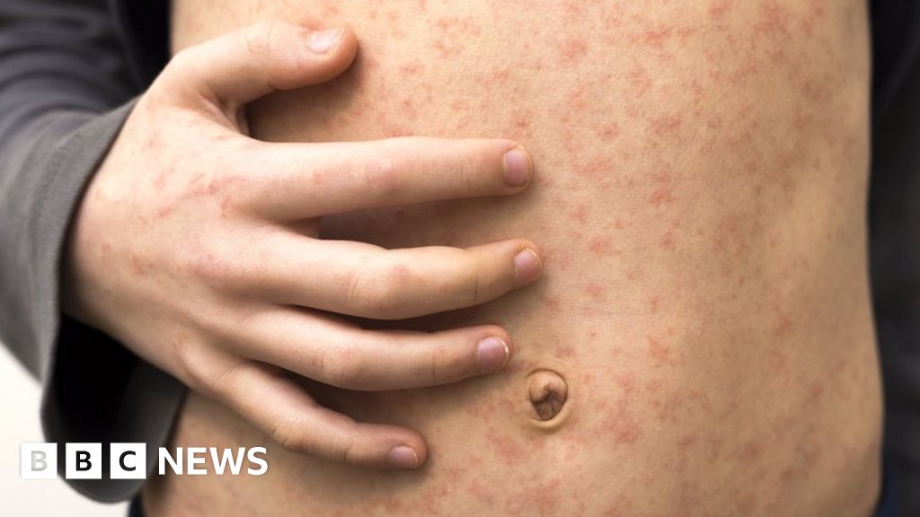 Rise in UK measles cases causing concern