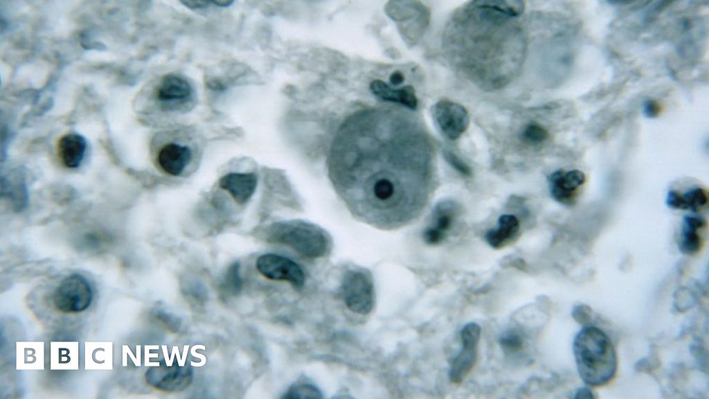 Brain-eating amoeba: Warning issued in Florida after rare infection case - BBC News