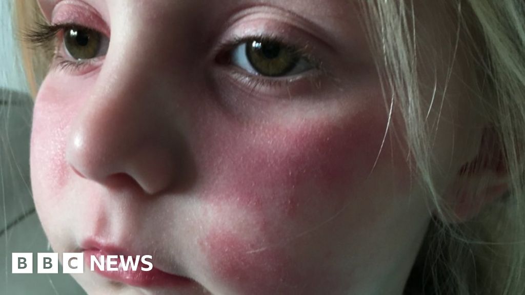 Rise in scarlet fever cases shows 49-year high, health experts say - BBC  News