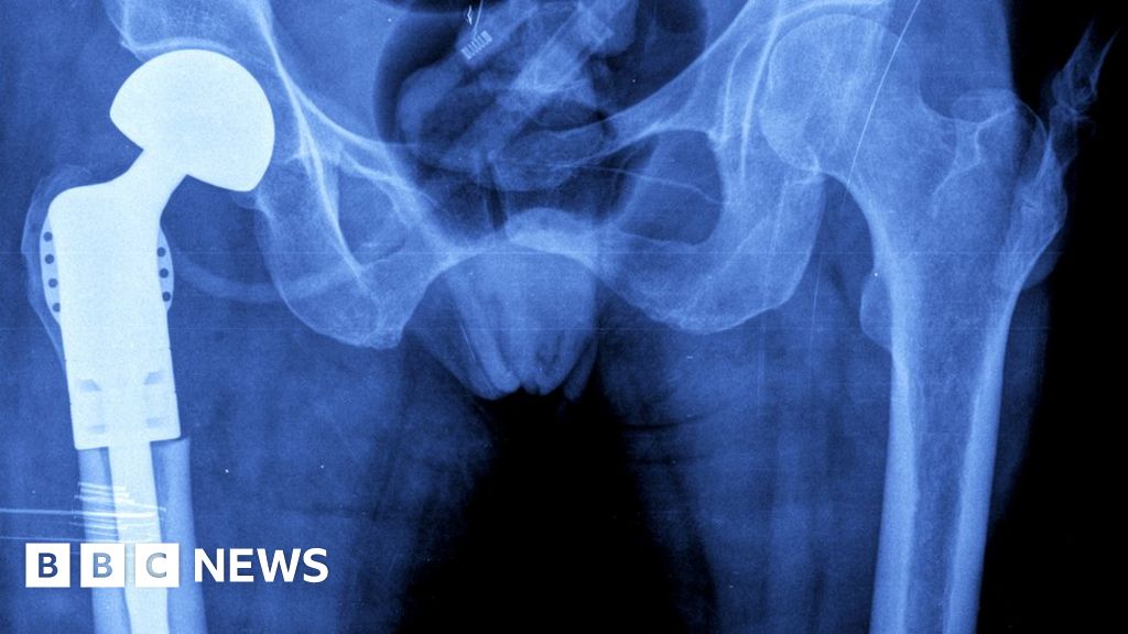 Zimmer Biomet creates new jobs at Bridgend factory BBC News