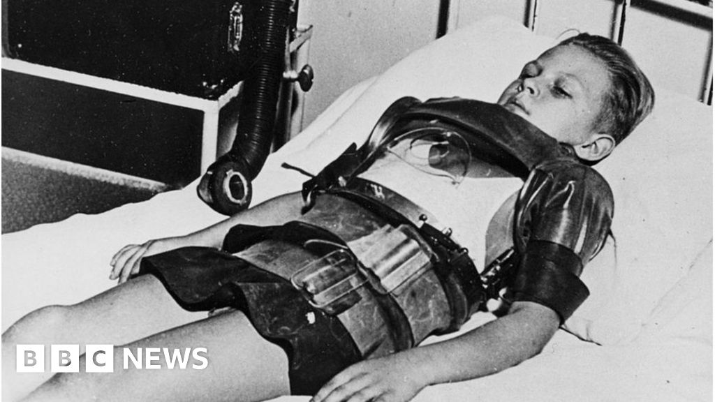 Polio Memories Of Self isolation In The 1950s