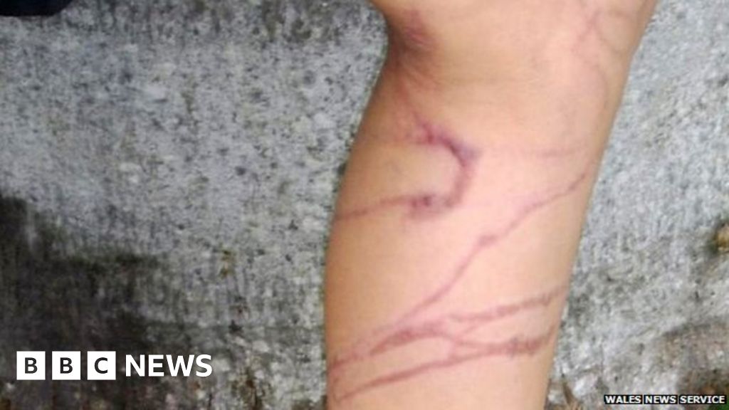 'Terrified' girl, 10, goes into shock after jellyfish sting BBC News