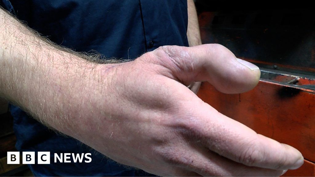 Man's thumb replaced with big toe after accident thumbnail