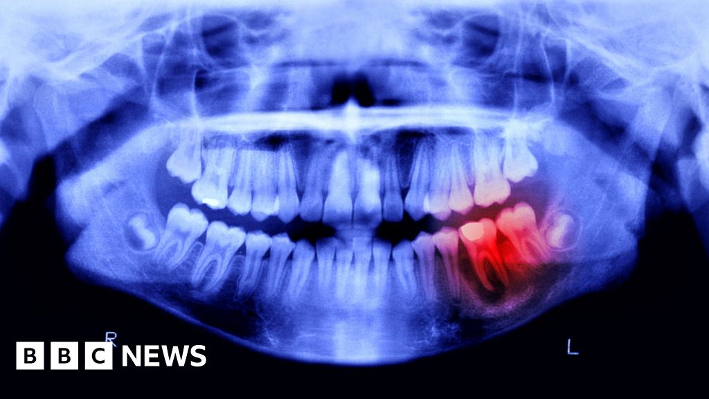 Covid Tooth loss fears over dentist checkup delays