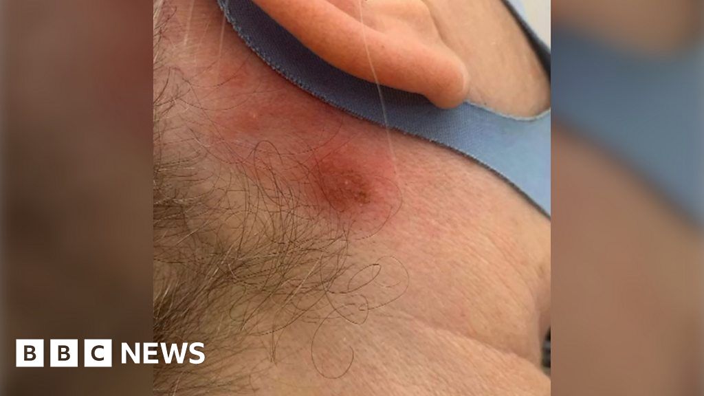 Covid-19: New Allergic Reactions To Hair Dye Reported - Bbc News