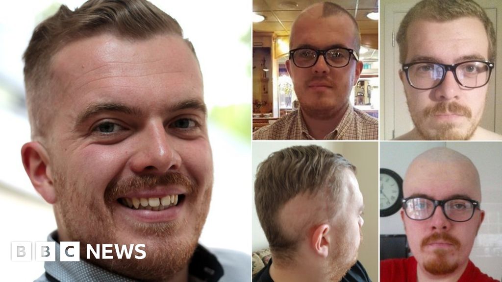 Cancer treatment: 'Men should talk about hair loss' - BBC News