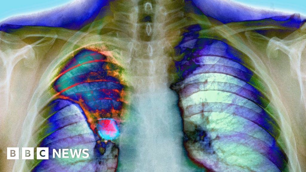 'London throat' Toxic brake dust could cause condition, scientists say