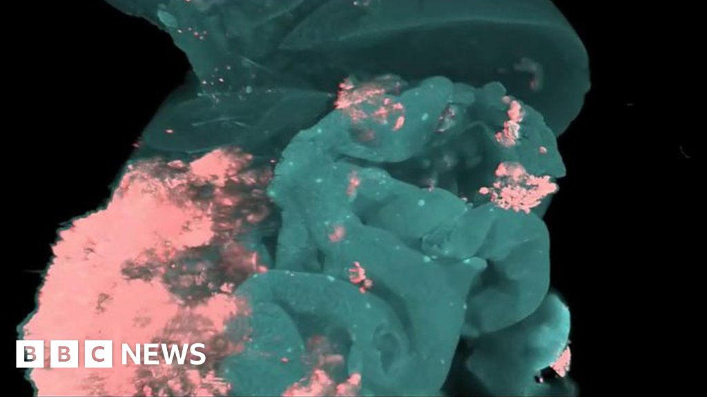 Spreading cancer caught on film - BBC News