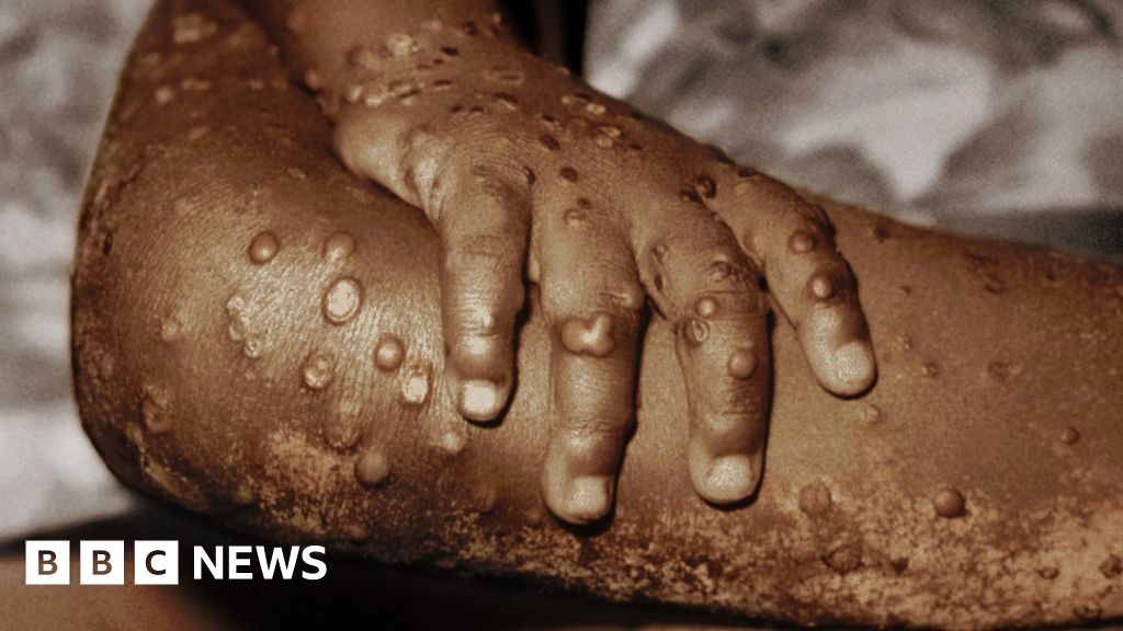 Monkeypox: Time to worry or one to ignore? - BBC