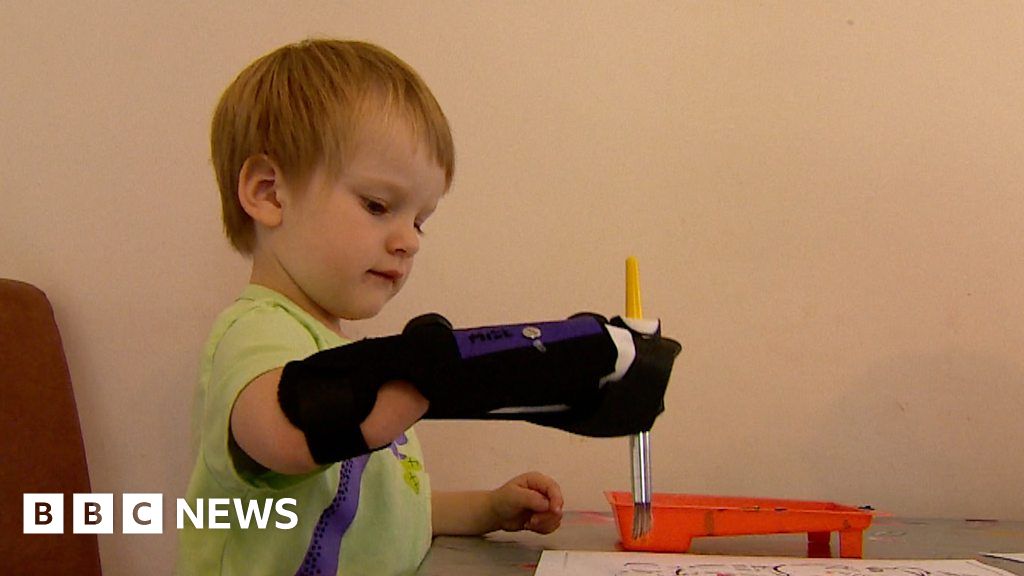 Super Hero, 3, Tries Out New Prosthetic Arm