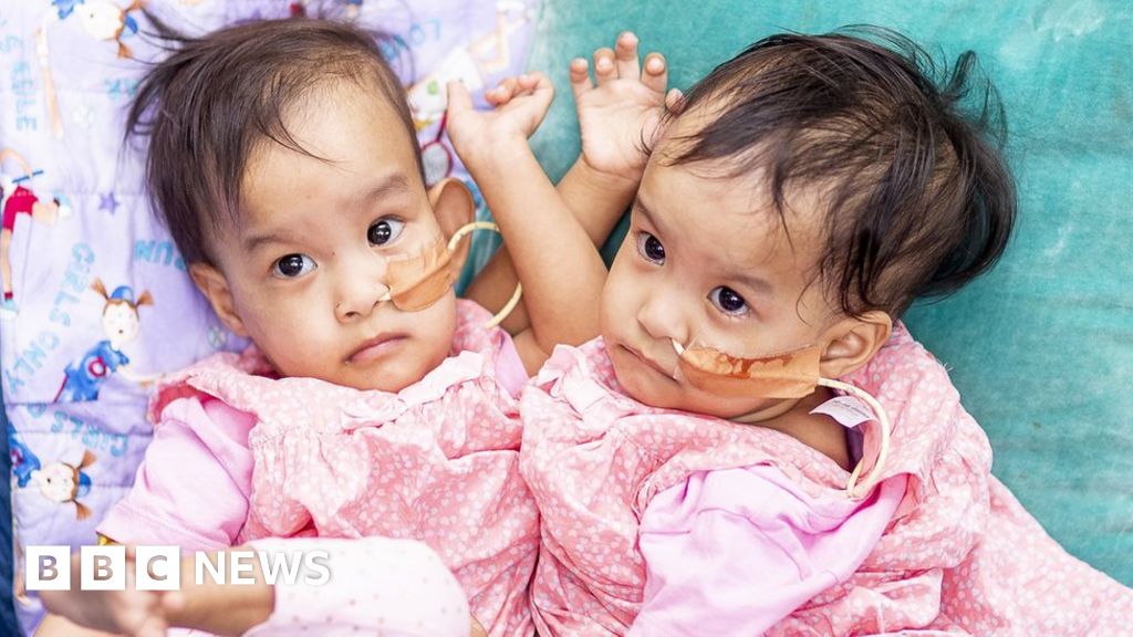 Conjoined Twins Bhutanese Girls Separated In Six Hour Surgery Bbc News