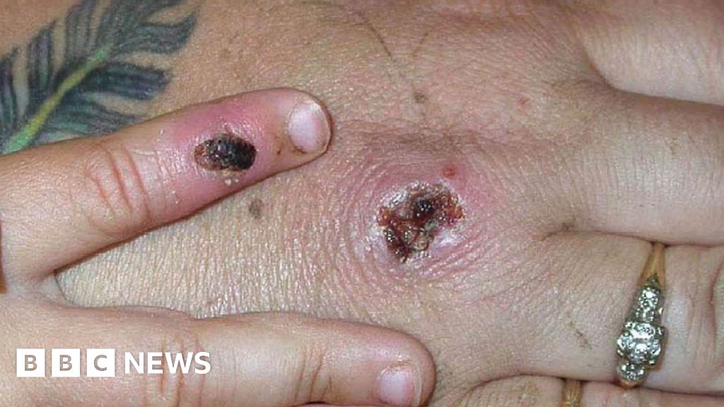 Monkeypox: First case confirmed in Wales