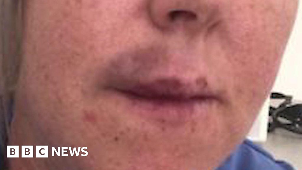 'I've seen girls with botched lip jobs' BBC News